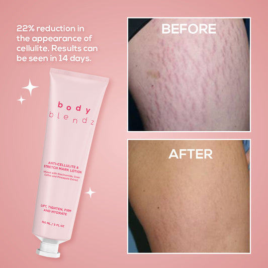Anti-Cellulite & Stretch Mark Lotion